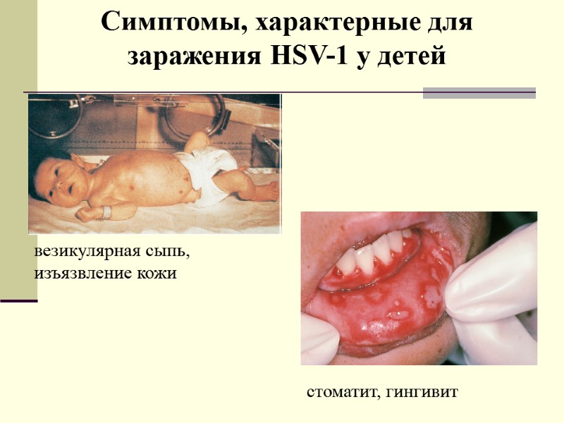 Симптомы, характерные для заражения HSV-1 у детей везикулярная сыпь, изъязвление кожи стоматит, гингивит